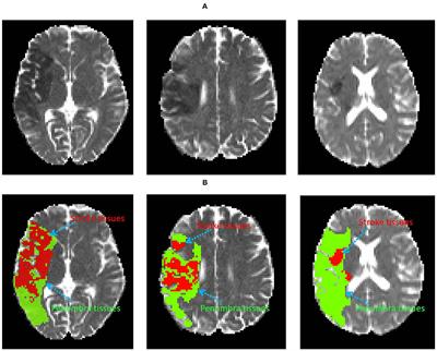 Co-optimization Learning Network for MRI Segmentation of Ischemic Penumbra Tissues